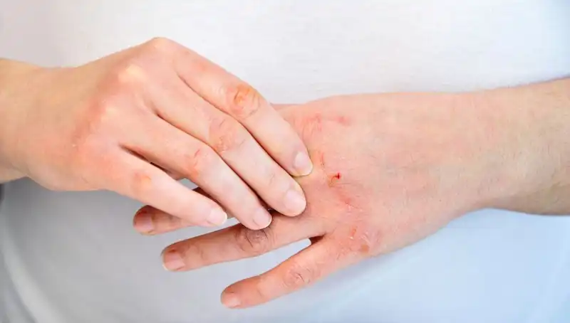 Yetersiz Protein Tüketimi: 6 Belirtinin Göz Önünde Bulundurulması Gerekiyor