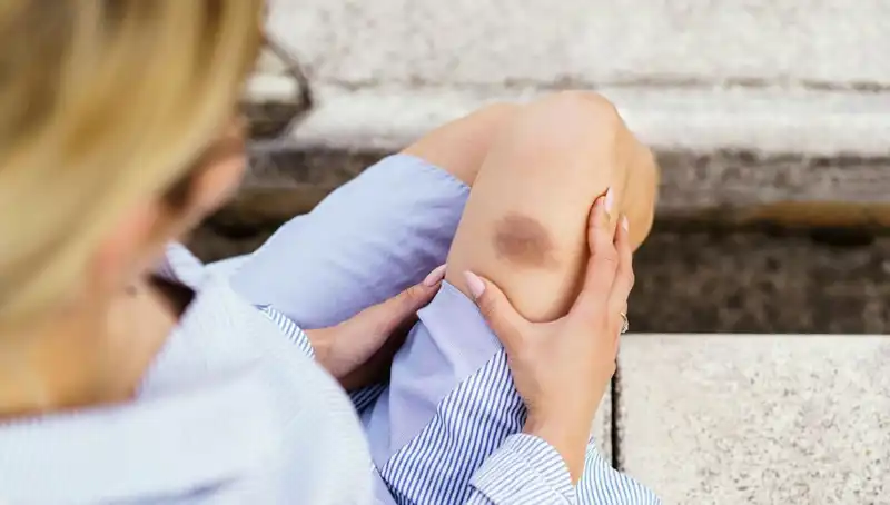 Vücuttaki Açıklanamayan Morluklar: Ölümcül Hastalıkların Belirtisi Olabilir!