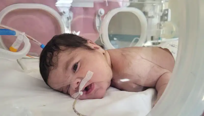Dünyada 7. Vaka: 34 Haftalık Eymen Bebeğin Boynundan Tümör Alındı